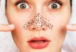 Penyebab Komedo Hitam di Hidung dan Cara Mengatasinya